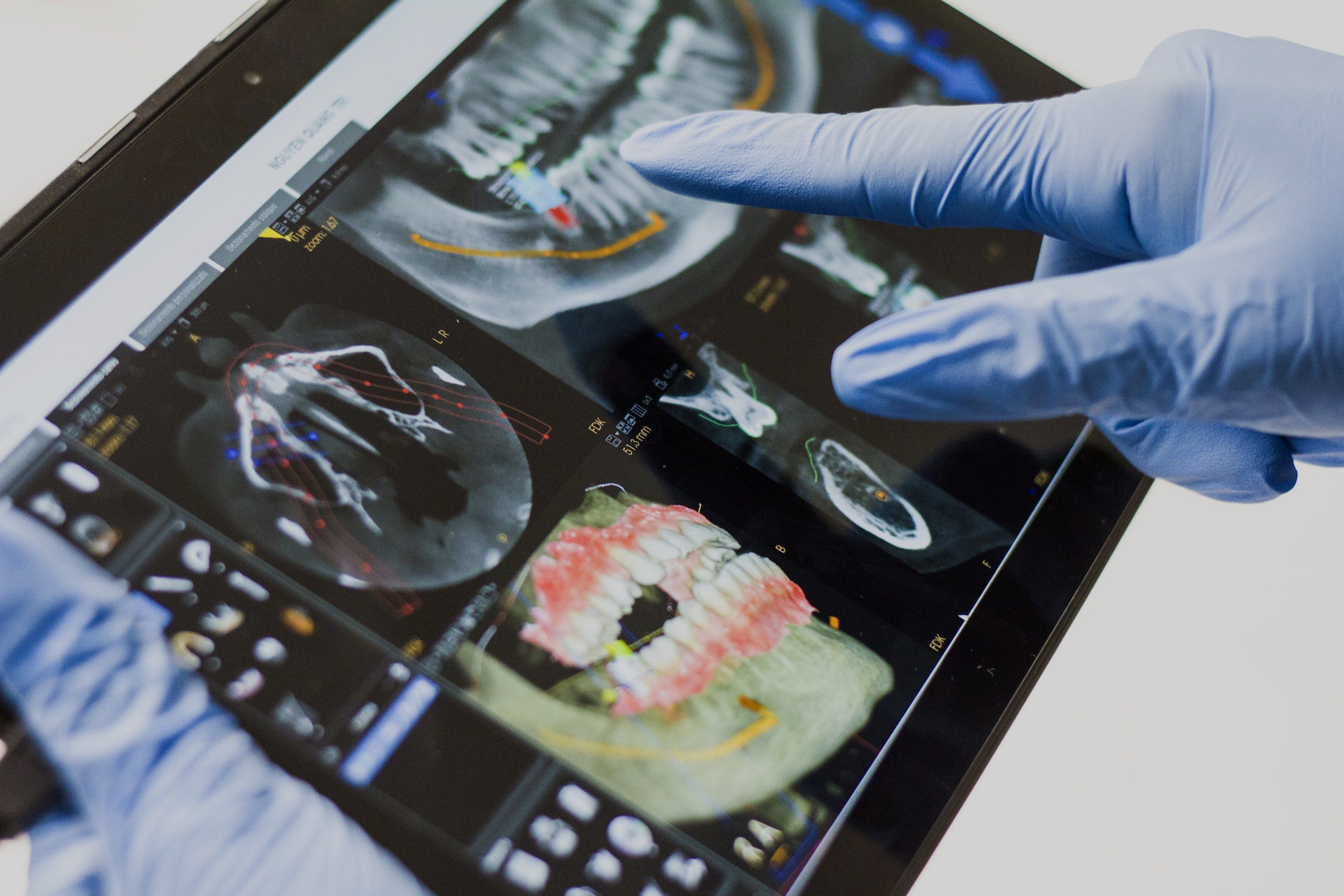 A dentist wearing gloves points to a digital X-ray of a patient's teeth and jaw on a tablet, analyzing the images for treatment planning - Dental Lab in Atlanta A dentist wearing gloves points to a digital X-ray of a patient's teeth and jaw on a tablet, analyzing the images for treatment planning - Dental Lab in Atlanta